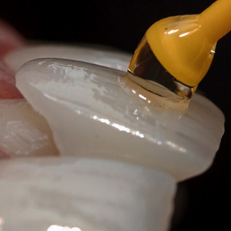 an up-close view of a veneer being placed on a tooth