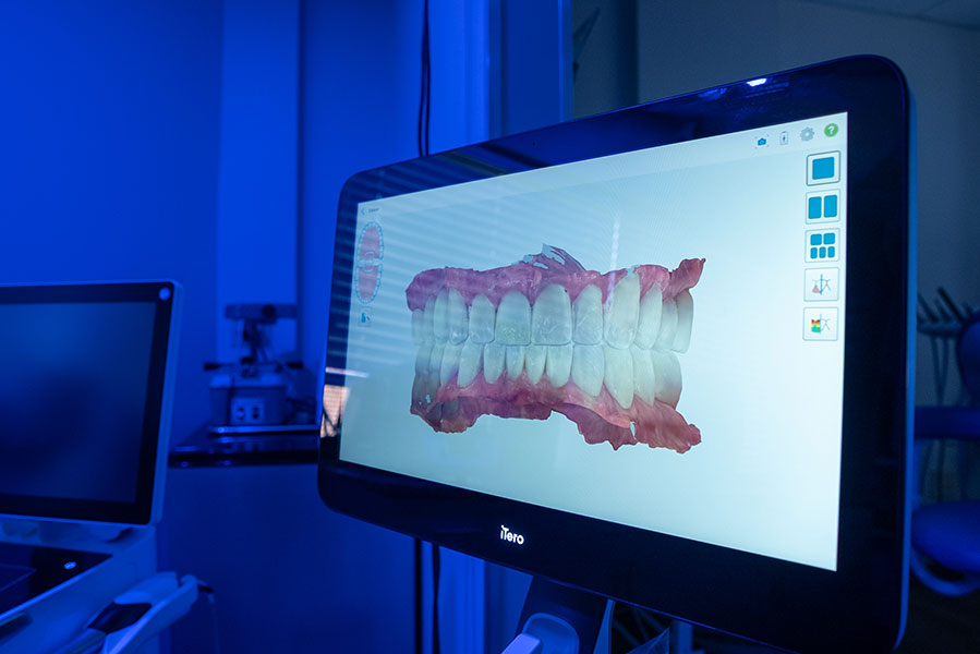 DentaCrafters PLLC | Sports Mouthguards, Veneers and Fluoride Treatment