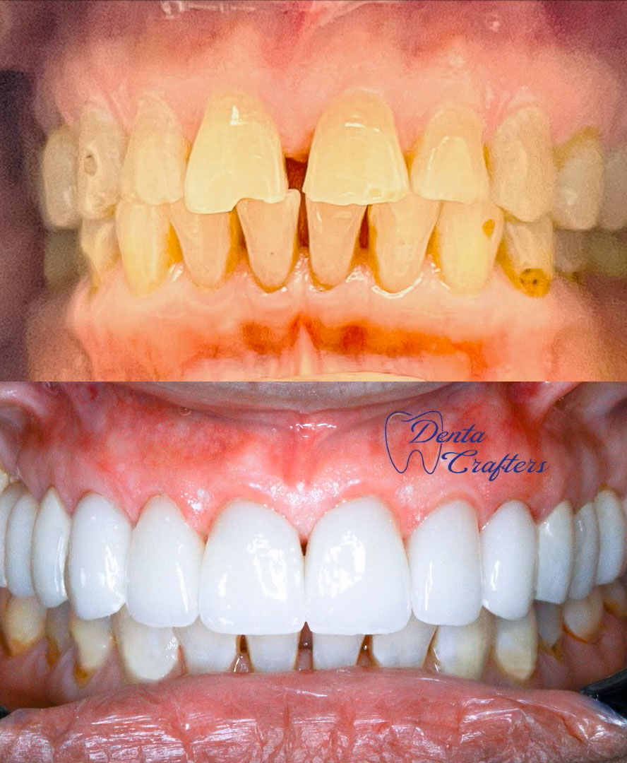 DentaCrafters PLLC | Invisalign reg , Veneers and All-On-X