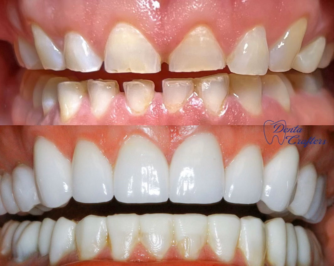 DentaCrafters PLLC | Dental Cleanings, Extractions and Fluoride Treatment