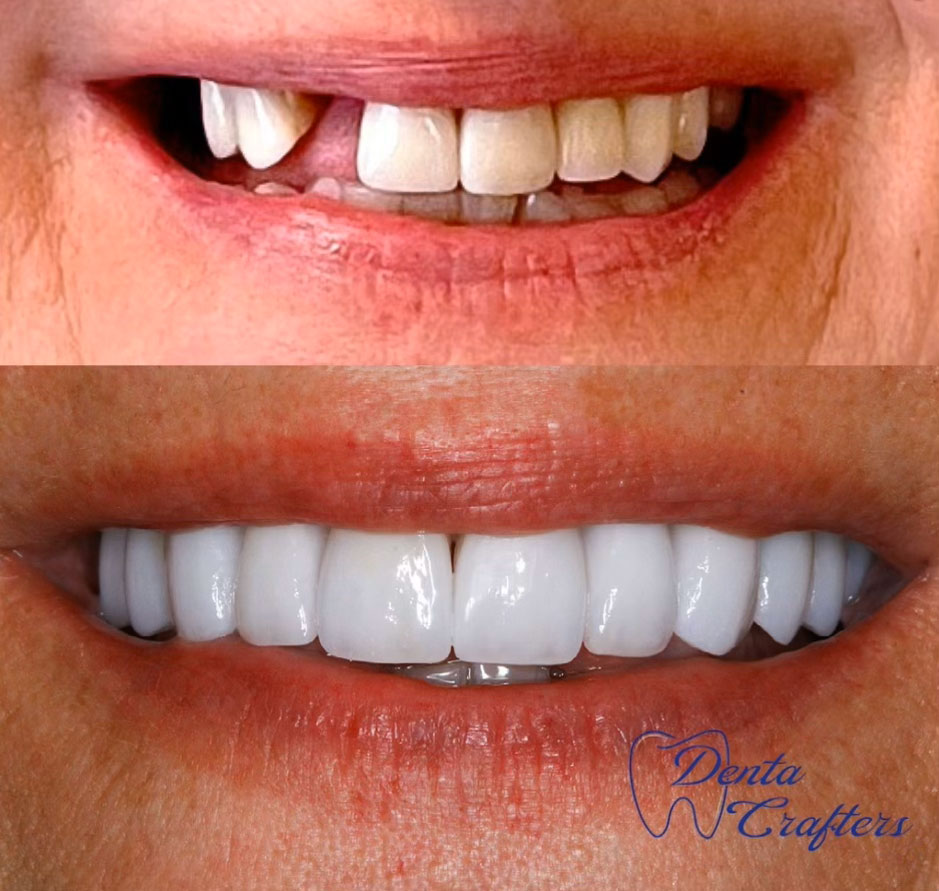 DentaCrafters PLLC | CBCT, Teeth Whitening and Implant Dentistry